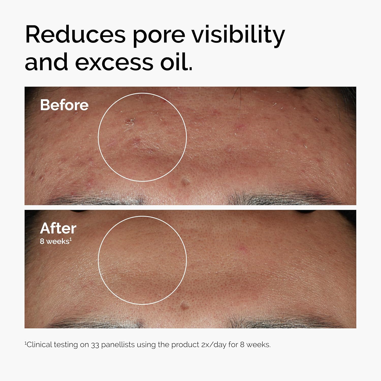 The Ordinary Niacinamide 10% + Zinc 1% Serum