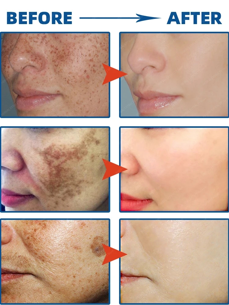 APGAR Dark Spot Remover For Face Removal Cream Age Sun Black Spots Freckles Melasma Spot nevus ointment