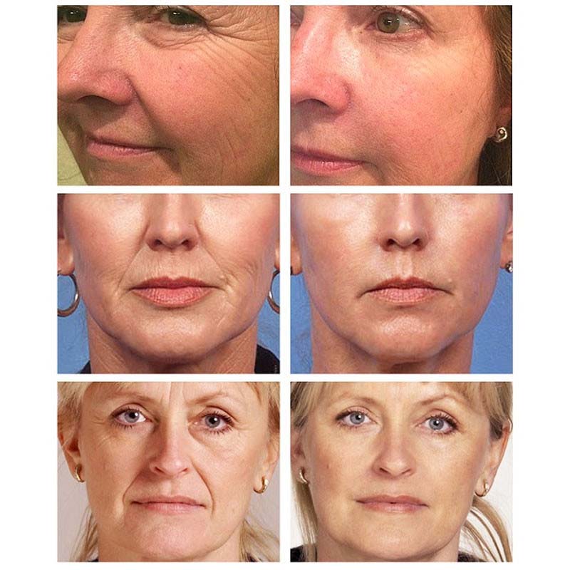 Retinol Wrinkle Remover Face Cream Anti-Aging Firming Lifting korean skin care products Fade Fine Lines Moisturizing Cosmetics
