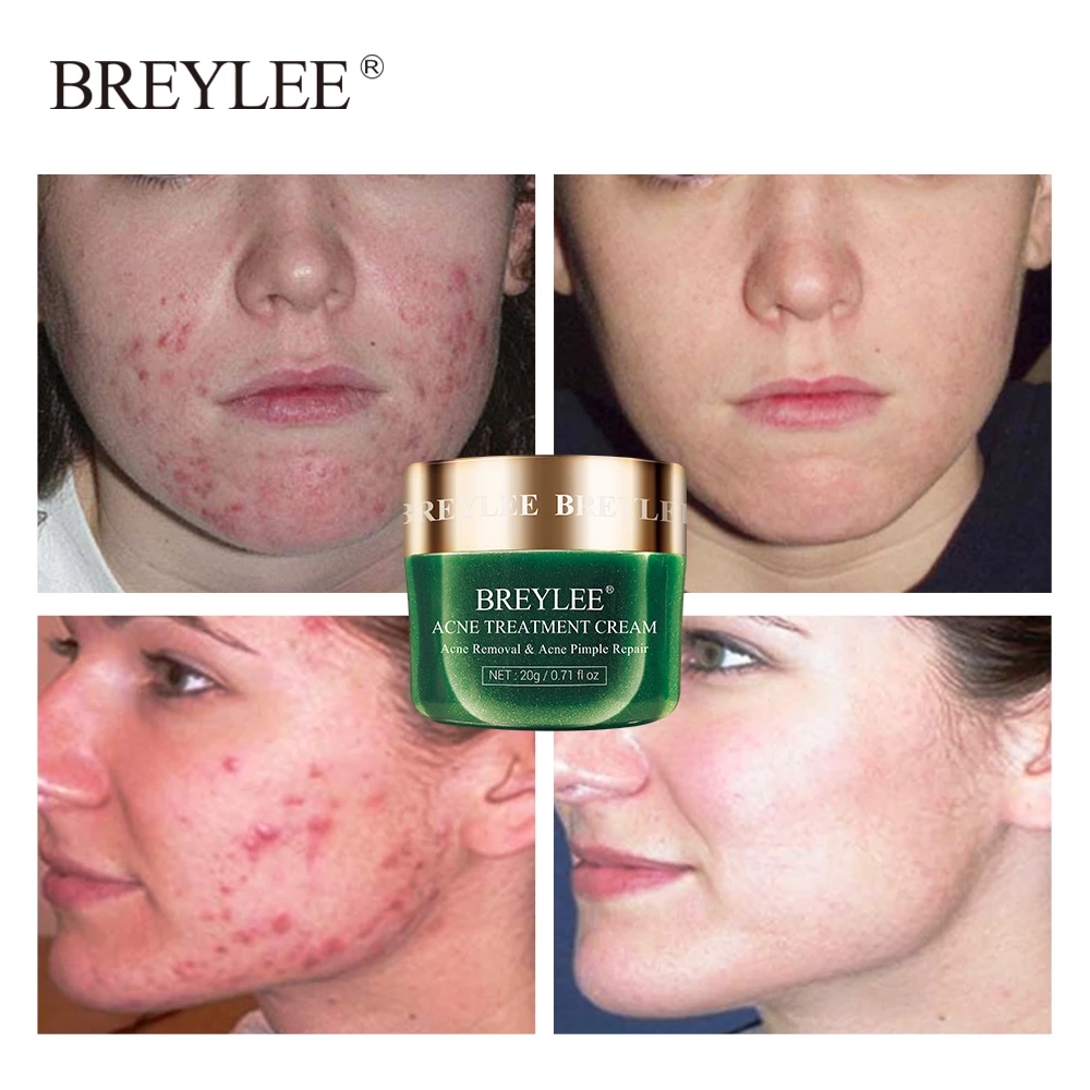 BREYLEE 20g Acne Treatment Cream Anti Acne Face Cream Pimple Removal Spots Oil Control Shrink Pores Moisturizing Skin Care Serum