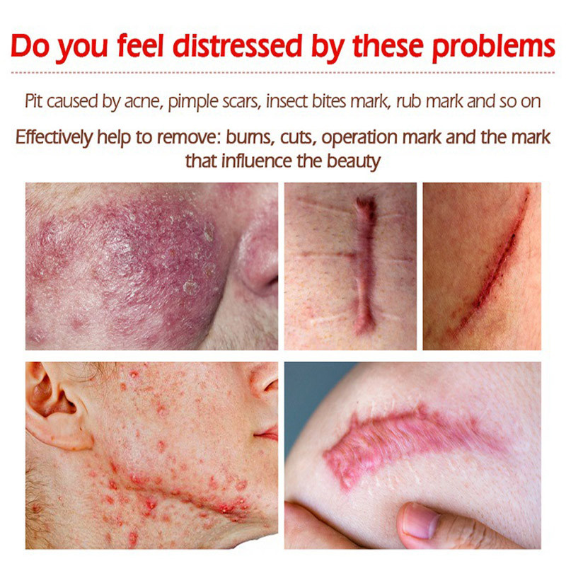 Acne Scar Removal Gel Treatment Surgical Scald Repair Cream Fade Dark Skin Pigmentation Postpartum Whitening Smooth Skin Care