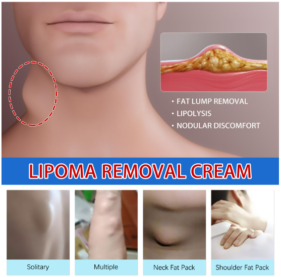 Fat Knot Cream relieves fat caking tumor subcutaneous lumps dredge body care cream