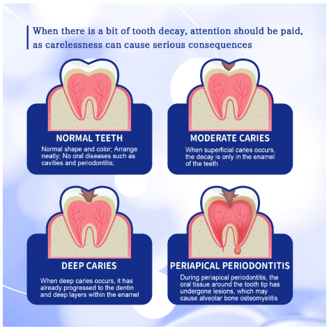 Anti Decay Toothpaste Dental Caries Repair Cream Prevent Tooth Decay Protect TeethDeep Clean Whitening & Fresh Breath Toothpast