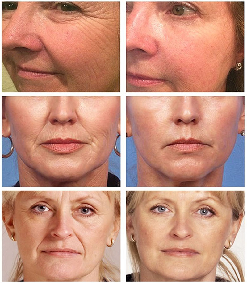 Retinol Anti-Wrinkle Cream Instant Anti Aging Firming Lifting Fade Fine Line Face Cream Moisturizing Nourish Skin Care