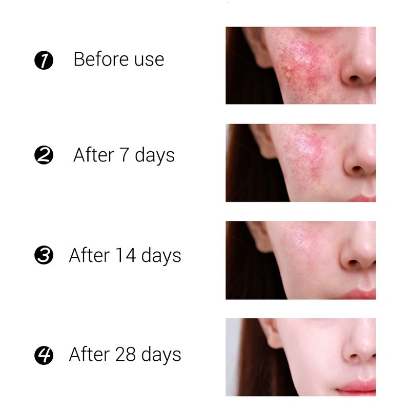 VOVA-Effective Acne Removal Cream Acne Spot Treatment Oil Control Pore Shrink Whitening Moisturizing Acne Skin Care Cream 30ml