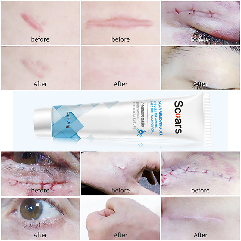 Herbal Scar Removal Cream Gel Repairing Pock Mark Burn Surgical Scar Cesarean Scar Stretch Marks Smooth Moisturizing Skin Care