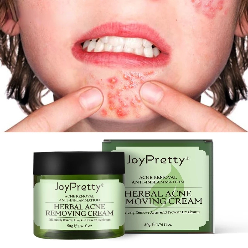 50g Herbal Day Cream For Acne Skin Care Face Moisturizer Oil Control Pimple Acne Scar Removal Cream Treatment Unisex