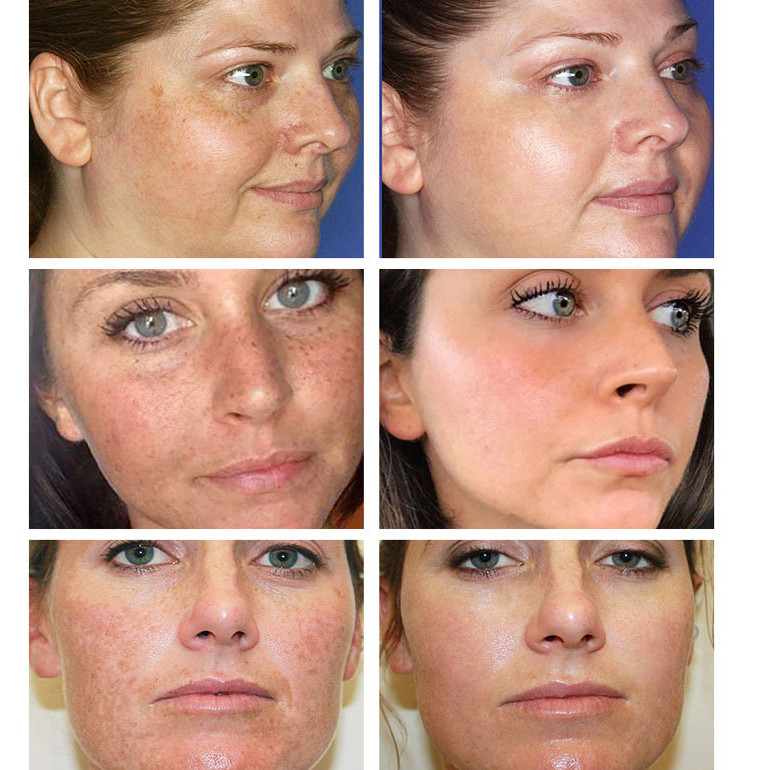 Effective Whitening Freckle Cream Remove Melasma Acne Spot Pigment Melanin Dark Spots Pigmentation Moisturizing Gel Skin Care
