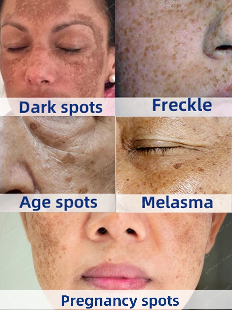 APGAR Dark Spot Remover For Face Removal Cream Age Sun Black Spots Freckles Melasma Spot nevus ointment
