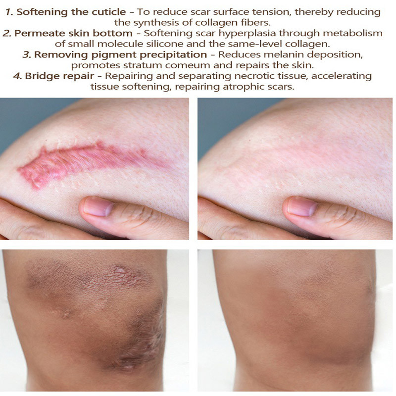 Acne Scar Removal Gel Treatment Surgical Scald Repair Cream Fade Dark Skin Pigmentation Postpartum Whitening Smooth Skin Care