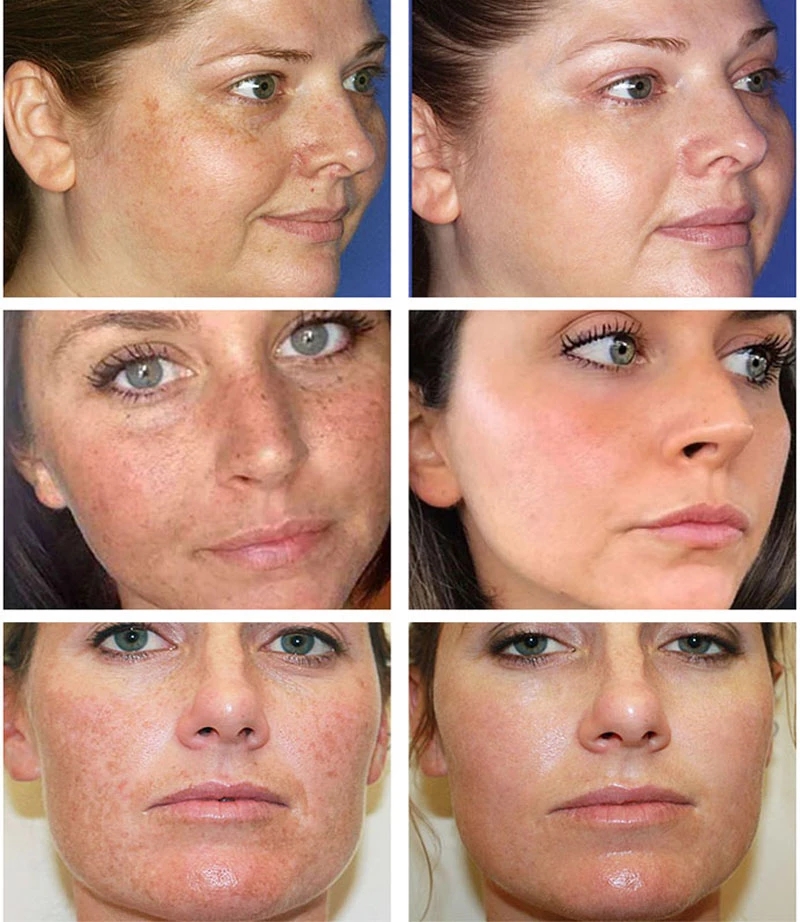 Whitening Freckle Cream Remove Melasma Cream Remove Dark Spots Melanin Melasma Remover Brighten Skin Anti-Aging Skin Lightening