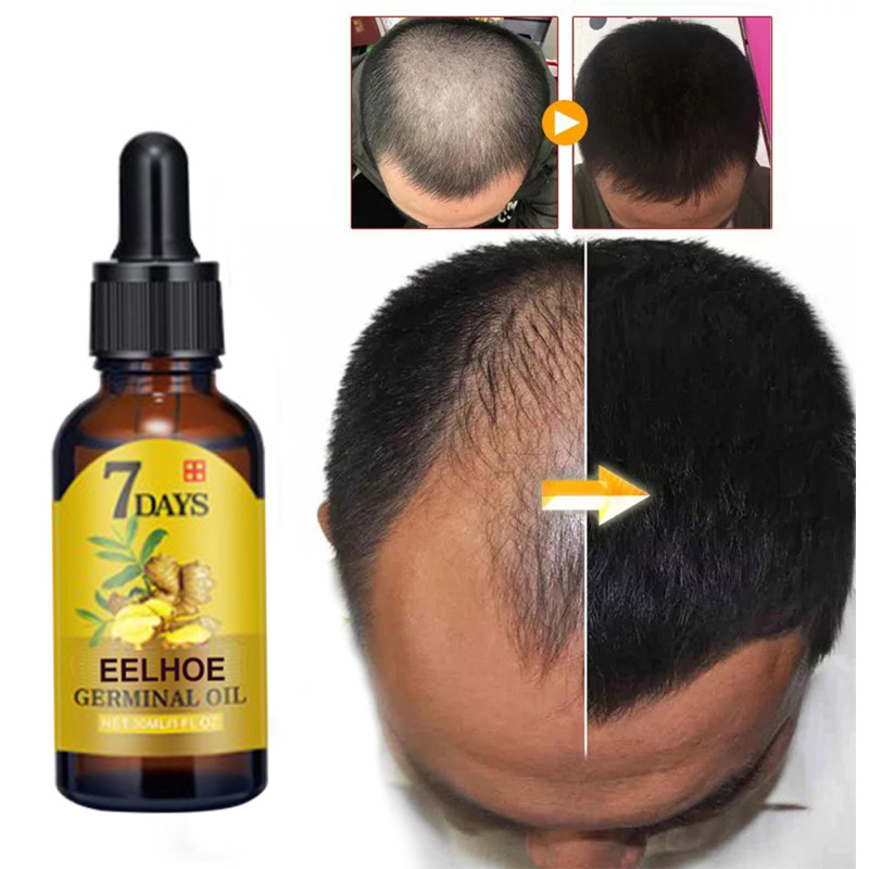 Ginger Hair Growth Fast Hair Growth Essential Oil Beauty Hair Care To Prevent Hair Loss Oil Scalp Care Nutrient Solution