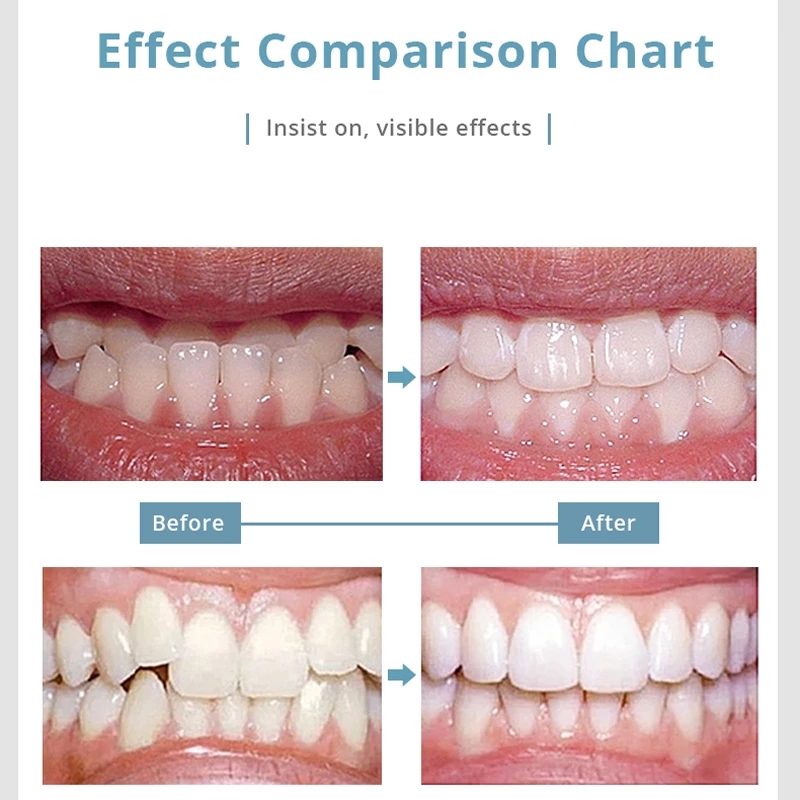 Mouth Braces Instanted Silicone Smile Teeth Alignment Trainer Teeth Retainer Mouth Guard Protective Tooth Tray 3 Stages