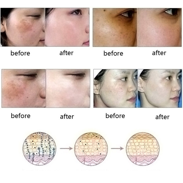 ultra brightening spotless oil skin care dark spots remove ance brun strentch marks scar removal brightening skin essence 30ml