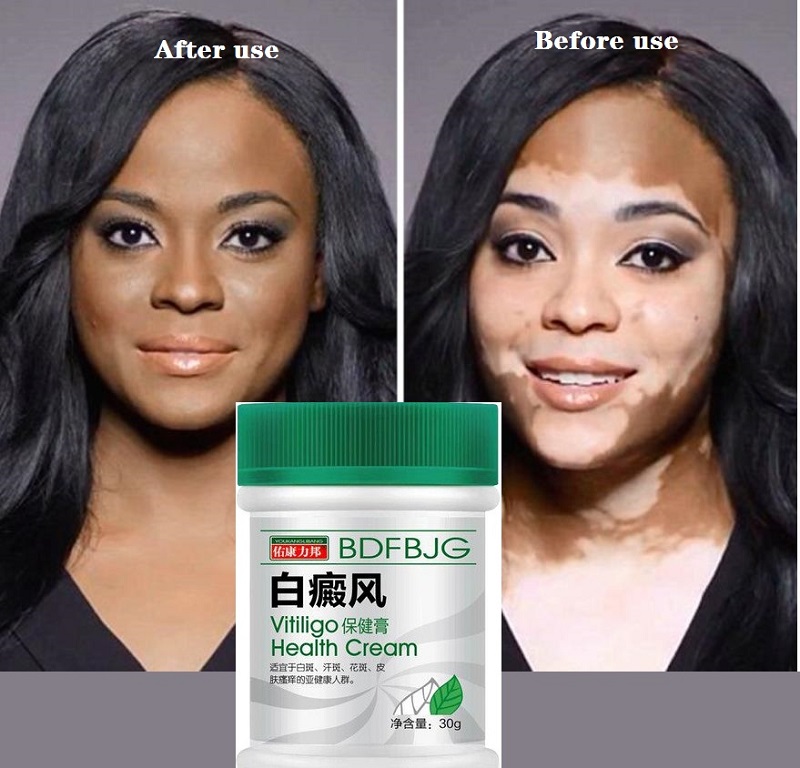 30G Vitiligo cream Antibacterial cream Psoriasis Localised Vitiligo Zalf White spot Mycosis Leucoplasia Treatment P1153