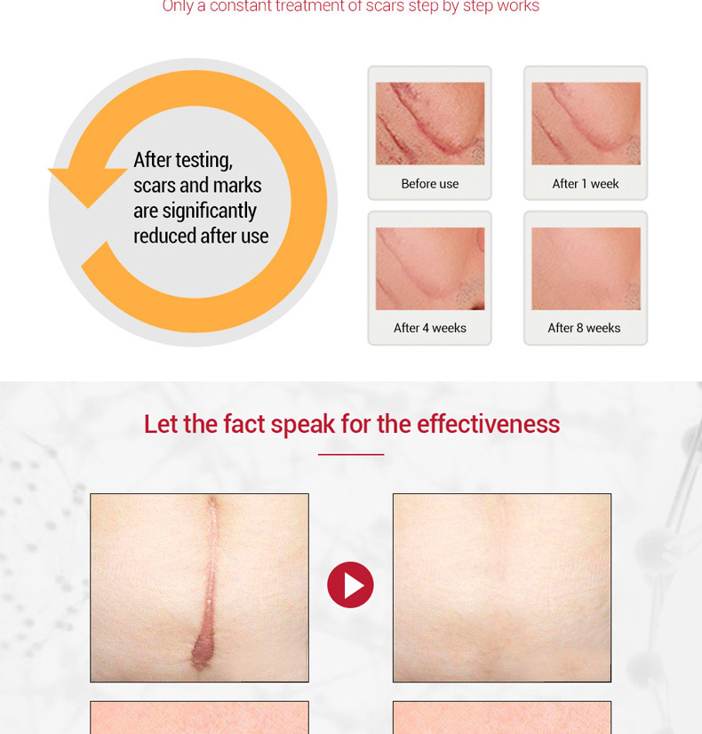 30g Acne Scar Removal Cream Gel Face Pimple Stretch Marks Repairing Cream Smoothing Whitening Moisturizing Skin Care Body Cream