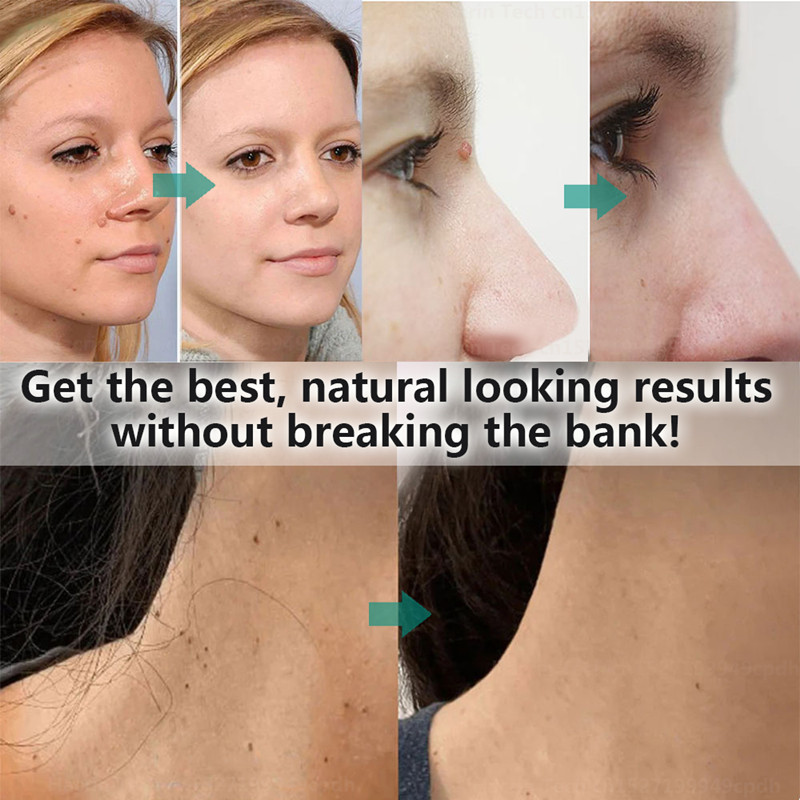 Skin Tag Remover 15 Level Laser Plasma Pen Freckle Mole Warts Removal Lcd Nevus Tattoo Black Spots Remover Blemish Removal