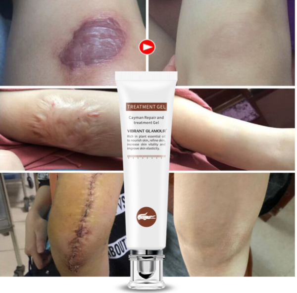 VIBRANT GLAMOUR Repair Scar cream Removal Acne Scars Stretch Marks CreamSurgical scar Burn For Body Pigmentation Corrector care