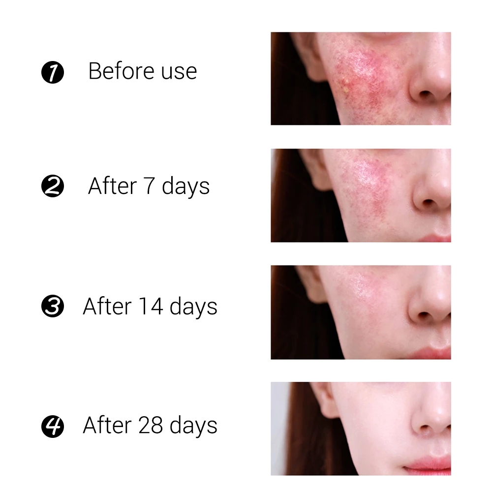 BREYLEE 20g Acne Treatment Cream Anti Acne Face Cream Pimple Removal Spots Oil Control Shrink Pores Moisturizing Skin Care Serum