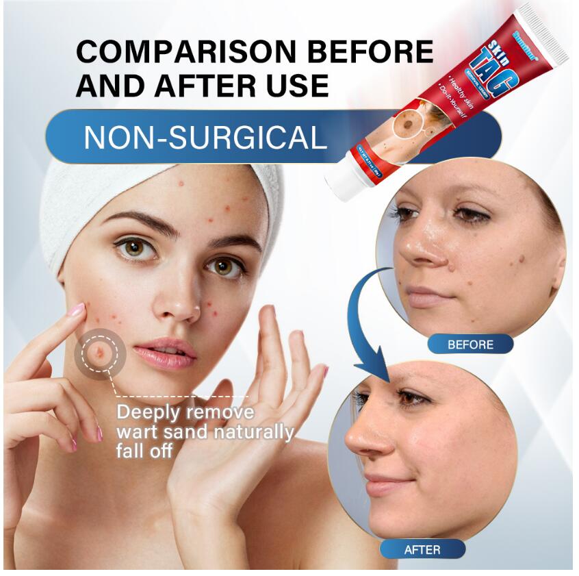 20g Removing Wart cream Cure Different Types Of Spots Skin Care