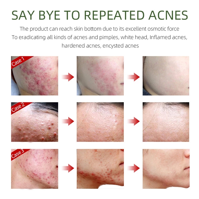 50g Herbal Day Cream For Acne Skin Care Face Moisturizer Oil Control Pimple Acne Scar Removal Cream Treatment Unisex