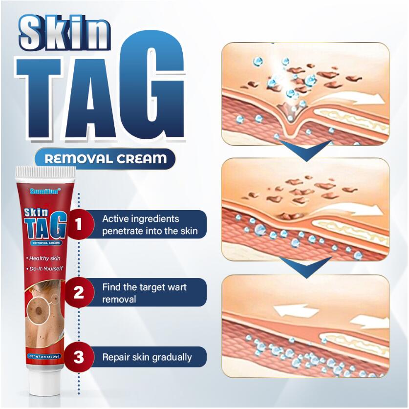 20g Removing Wart cream Cure Different Types Of Spots Skin Care