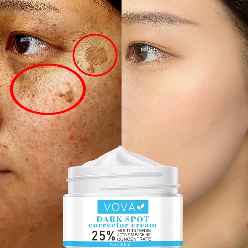 Effective Whitening Freckle Cream Remove Melasma Acne Spot Pigment Melanin Dark Spots Pigmentation Moisturizing Gel Skin Care