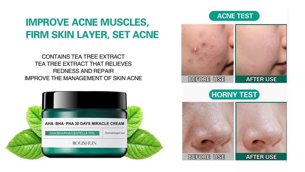 Korean Cosmetics Tea Tree Cream AHA BHA PHA 30 Days Miracle Cream Face Care Acne Treatment Whitening Oil Control Moisturizer