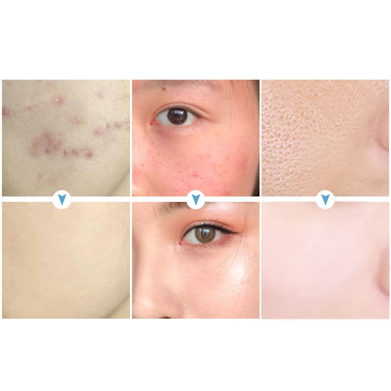 VOVA-Effective Acne Removal Cream Acne Spot Treatment Oil Control Pore Shrink Whitening Moisturizing Acne Skin Care Cream 30ml