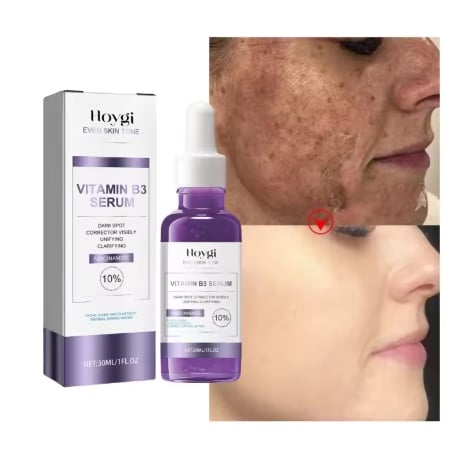 Powerful Dark Spots Remover Whitening Serum Face Freckle Melanin Correcting Anti Pigmentation Brighten Skin Beauty Care Essence