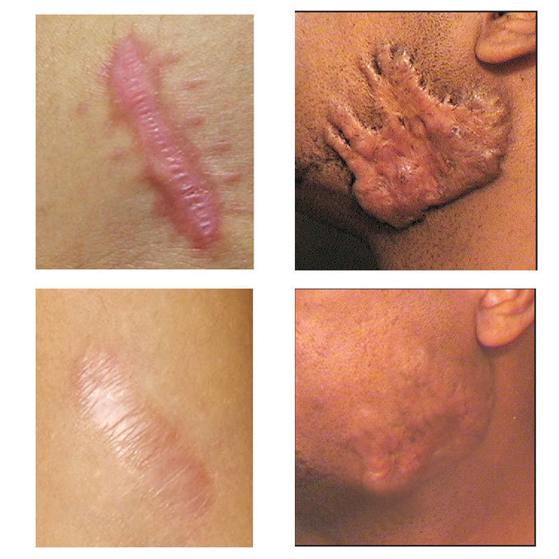 Acne Scar Removal Gel Treatment Surgical Scald Repair Cream Fade Dark Skin Pigmentation Postpartum Whitening Smooth Skin Care