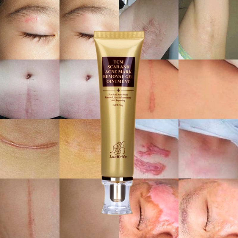 LANBENA 30ml Acne Scar Removal Cream Skin Repair Face Cream Acne Spots Acne Treatment Blackhead Whitening Cream Stretch Marks