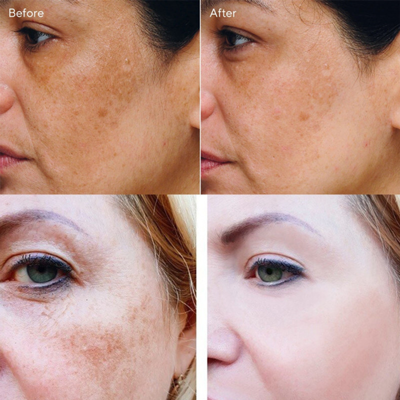 Whitening Freckle Cream Remove Melasma Acne Spot Pigment Melanin Dark Spots Pigmentation Freckle Removal Cream Moisturizing Gel