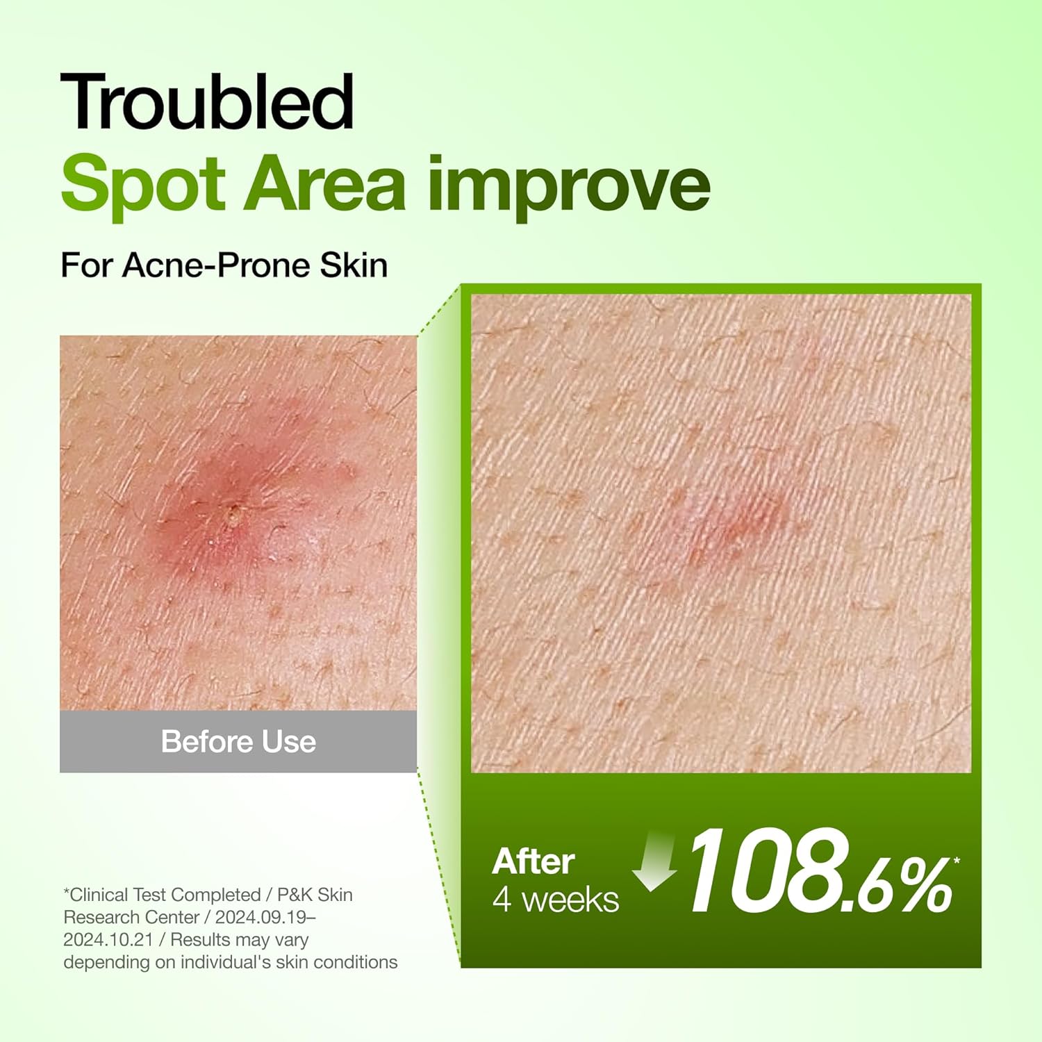 Anua Azelaic Acid 10 Hyaluron Redness Soothing Serum, Facial Serum for Blemish-Prone & Oily-Prone Skin, Lightweight & Hydrating Blemish Care, Hyaluron