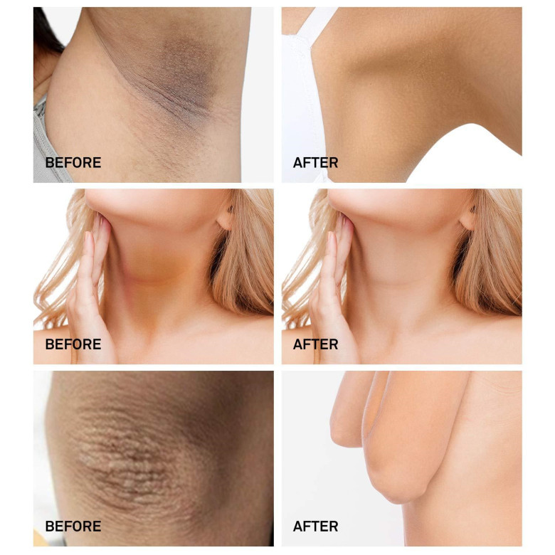 Armpit Whitening Cream Skin Lightening Bleaching Cream Underarm Dark Skin Legs Knees Whitening Intimate Body Lotion