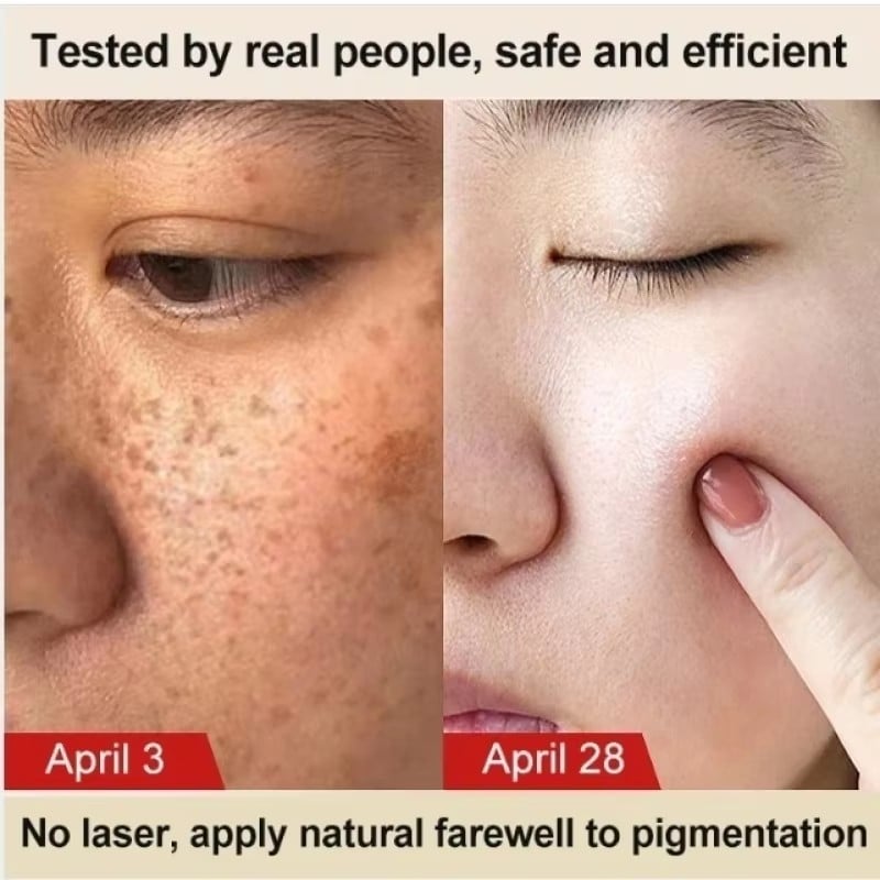 Astragalus Whitening Freckles Cream Face Dark Spots Remover Repair Products Removal Melasma Melanin Moisturiz Brighten Skin Care