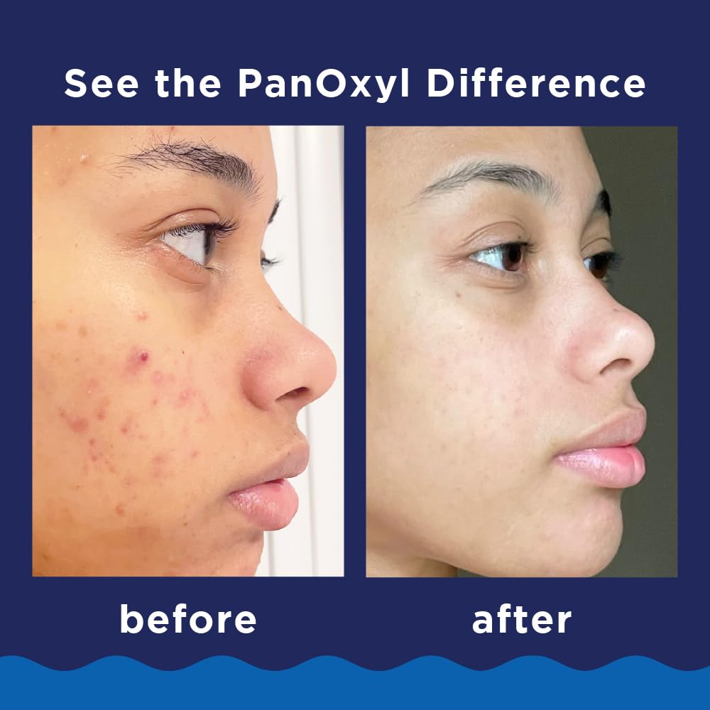 PanOxyl 10% Benzoyl Peroxide Acne Foaming Wash, Maximum Strength, Daily Acne-Fighting Face & Body Cleanser, Face Wash to Clear, Treat and Prevent Acne