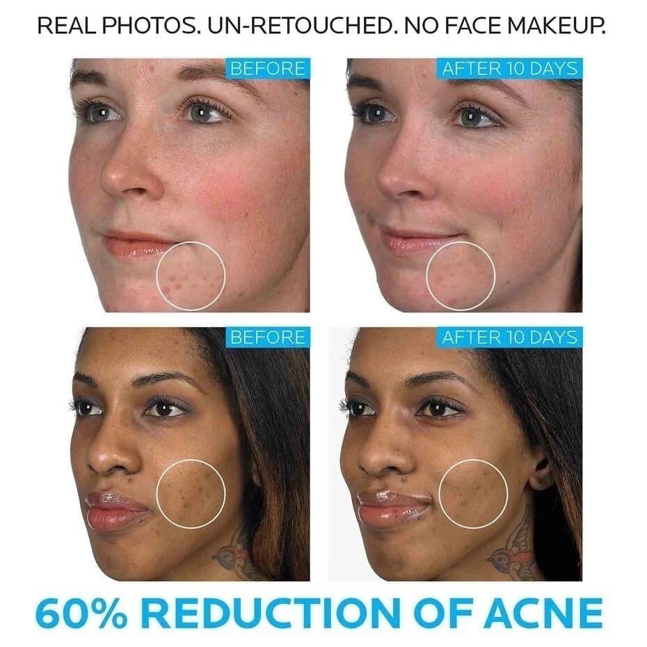 La Roche Posay Effaclar Duo (+) Acne Pimple Remover/Acne Spot Treatment Acne Scar Marks Remover Repair Whitening Skin Care 40ml