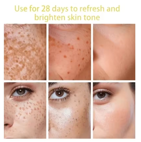 Dark Spots Remover Whitening Serum Face Freckle Melanin Correcting Anti Pigmentation Brighten Beauty Korean Day Night Skin Care