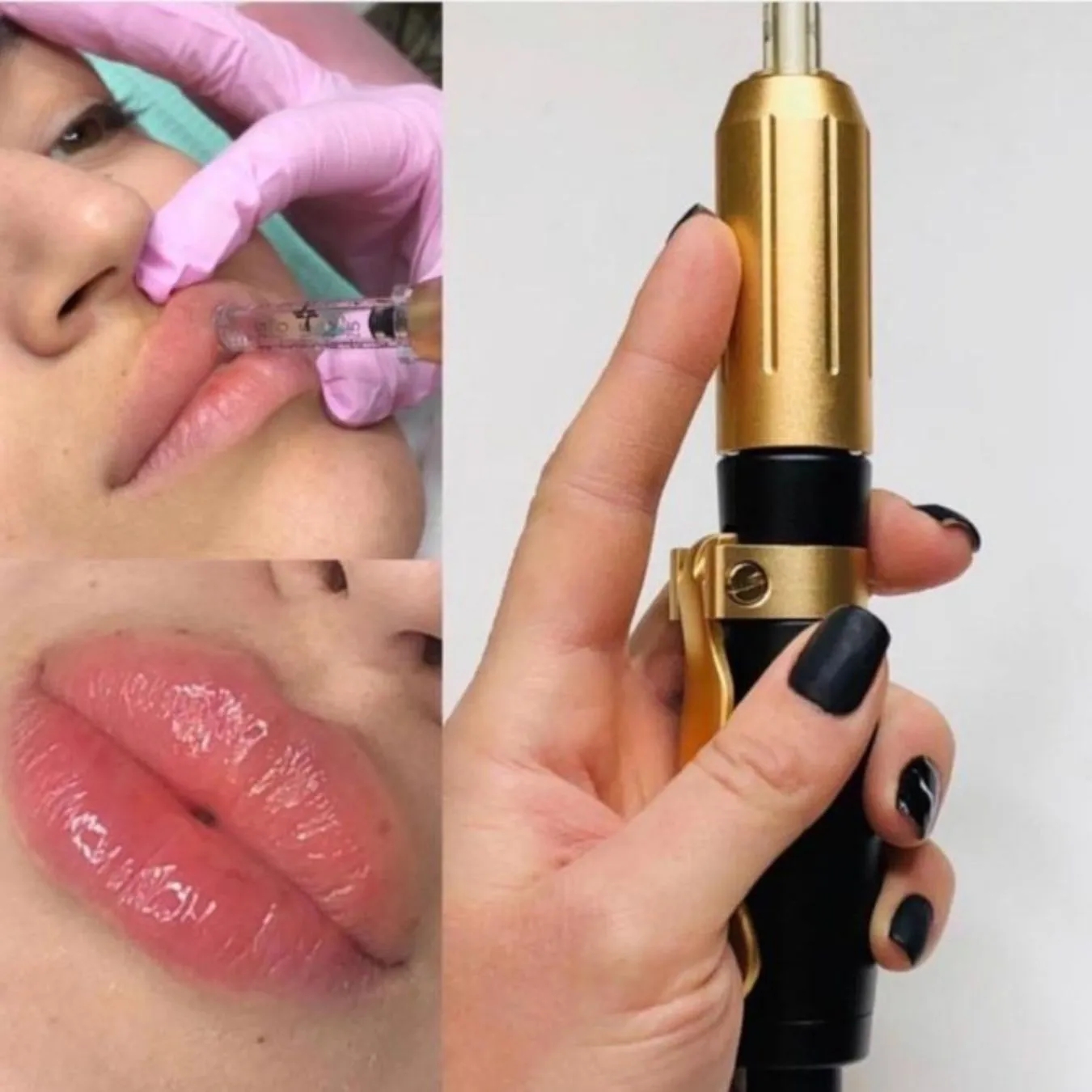 Caneta Mesoterapia Pressurizada Manual Para Intradermoterapia Facial E Corporal