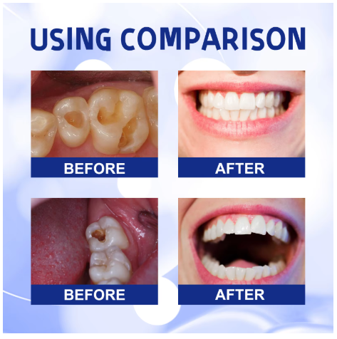 Anti Decay Toothpaste Dental Caries Repair Cream Prevent Tooth Decay Protect TeethDeep Clean Whitening & Fresh Breath Toothpast