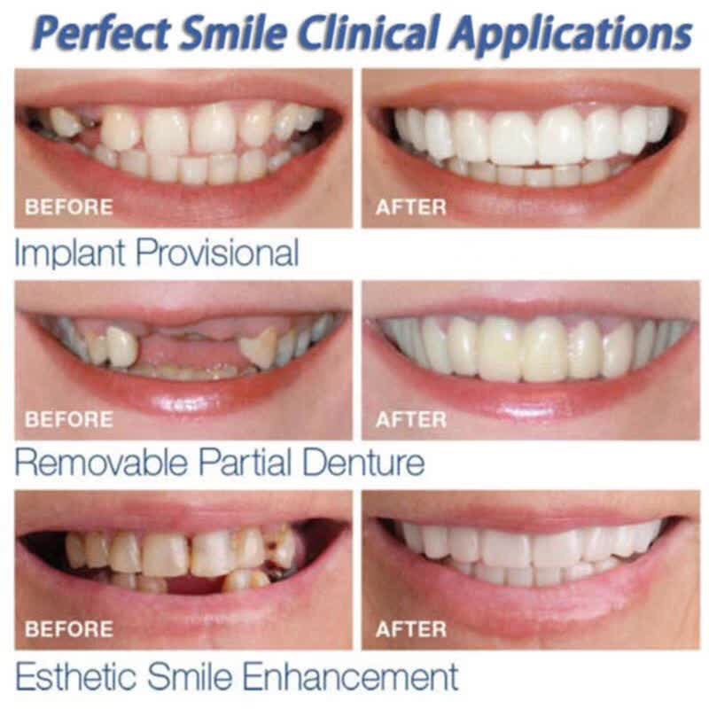 Beautiful Smile Denture Care Creative Teeth Temporary Anti-false Denture