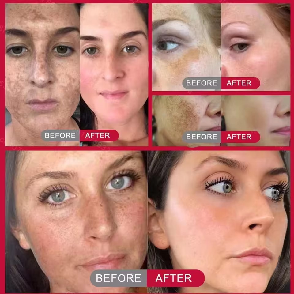 Powerful bleaching cream removing stains, lightens the skin, quickly removes melanin pigmentation, melasma, dark spots
