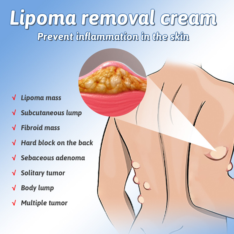 South Moon Fat Nodule Cream Relieves Fat Lumps and Hard Bulges, Eliminates Tumor Cream Improves Fat Nodules Cream