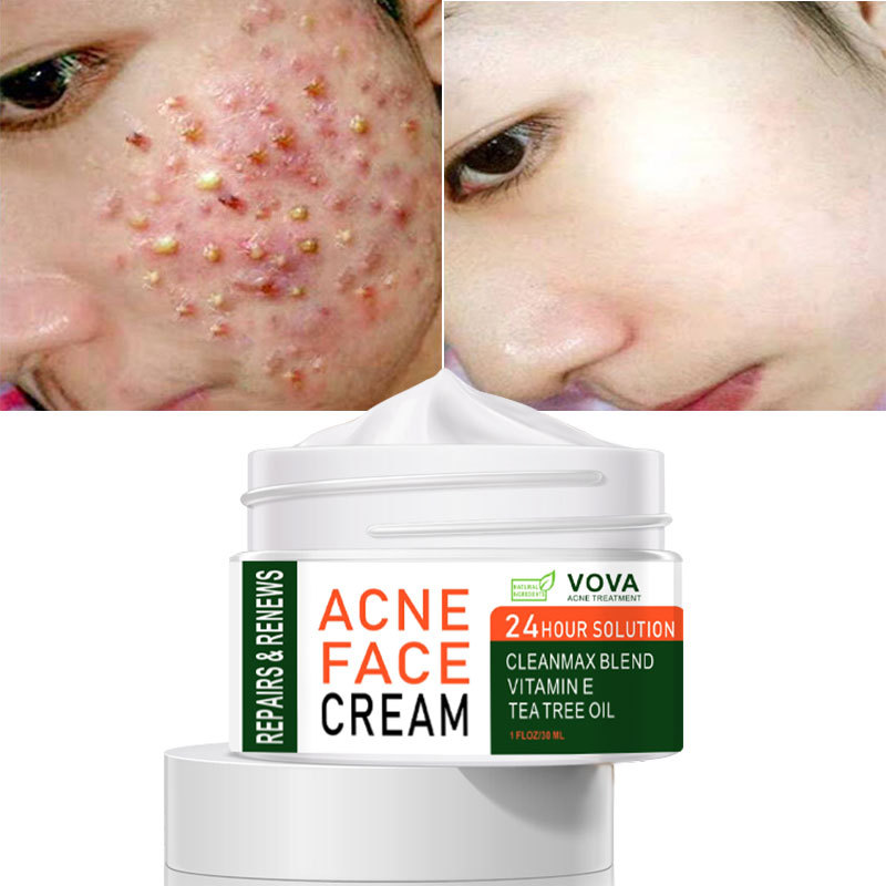 VOVA-Effective Acne Removal Cream Acne Spot Treatment Oil Control Pore Shrink Whitening Moisturizing Acne Skin Care Cream 30ml