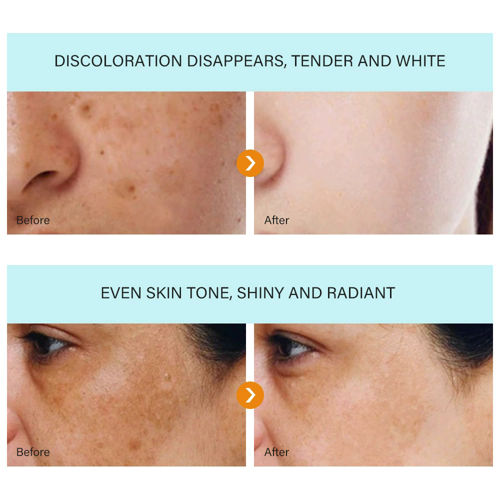 1PC DARK SPOT REMOVAL CREAM WHITENING FRECKLE CREAM