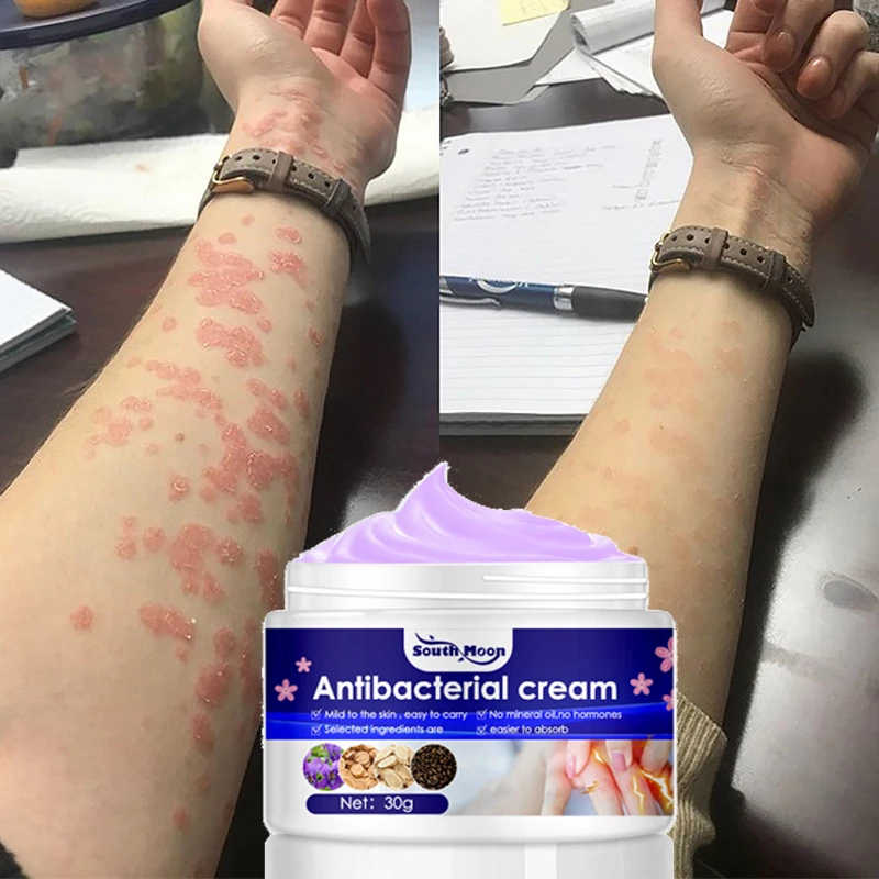 Psoriasis Dermatitis Eczematoid Eczema Ointment Anti-Itch Chinese Herb Medical Skin Care Cream