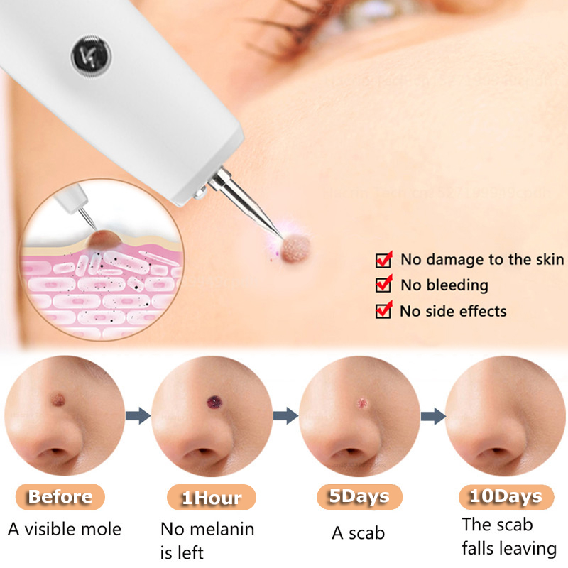 Skin Tag Remover 15 Level Laser Plasma Pen Freckle Mole Warts Removal Lcd Nevus Tattoo Black Spots Remover Blemish Removal