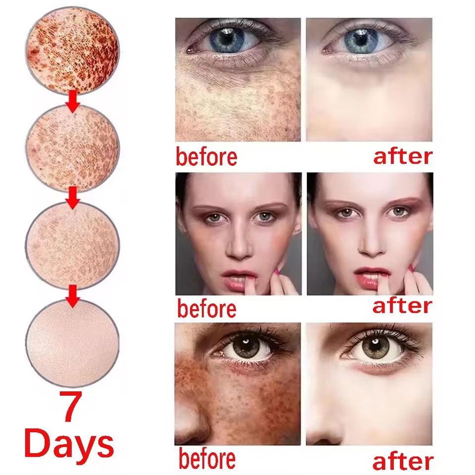 Powerful bleaching cream removing stains, lightens the skin, quickly removes melanin pigmentation, melasma, dark spots