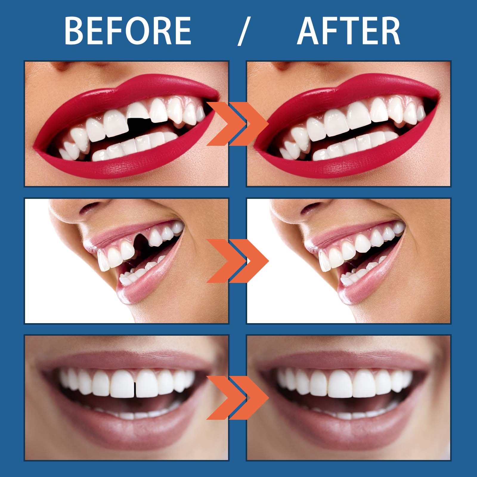 25g of Moldable Plasticized Gutta Percha for Temporary Dental Recovery and Filling of Teeth